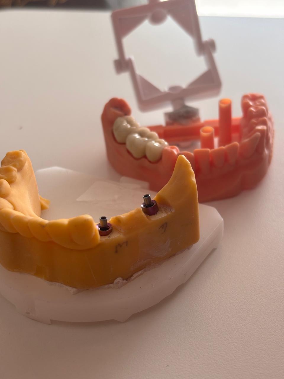 Guided Implant Surgery Planning